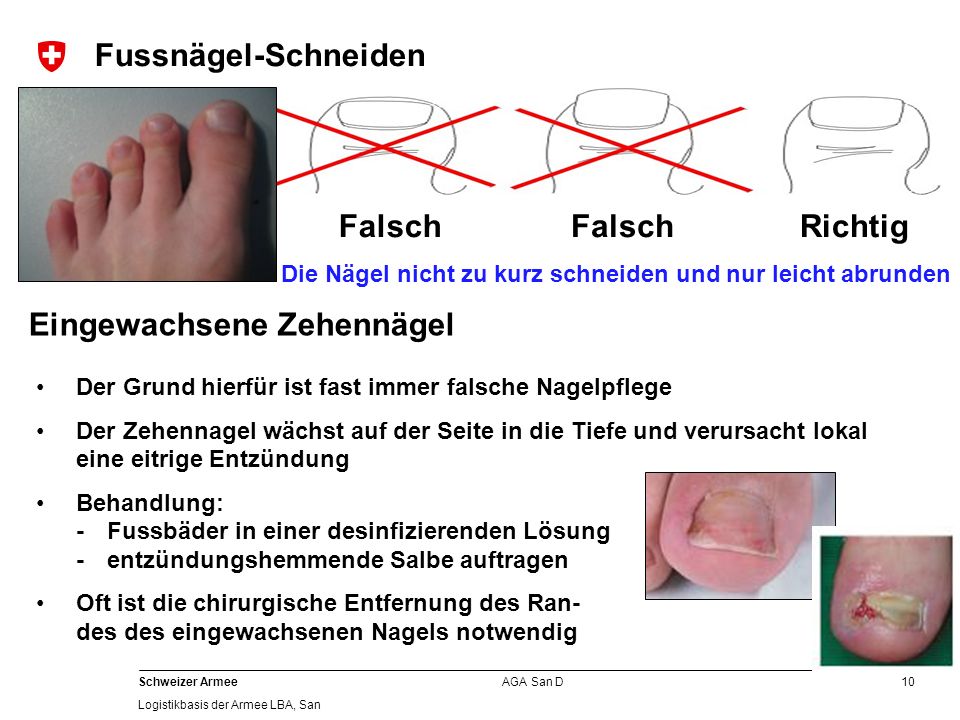 Wie gribok die Halse flukonasolom zu behandeln